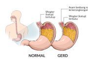 GERD atau penyakit Asam Lambung Bukan Penyakit biasa