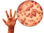 Surabaya Siapkan Lokasi Isolasi, Antisipasi Monkeypox!