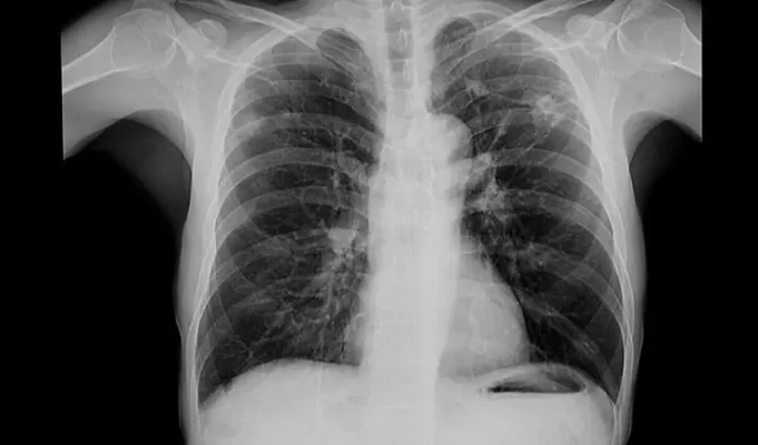 tuberculosis-840x493.jpg