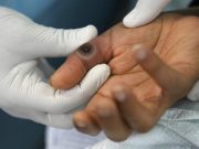 Kasus Mpox di RI mencapai 55. Simak kembali cara menghilangkan bekas cacar monyet