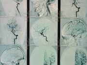 Mengenal DSA Digital Subtraction Angiography (DSA): Teknologi Pencitraan Medis yang Akurat