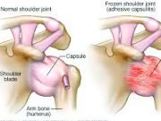 Penyebab, Gejala, dan Pengobatan Frozen Shoulder yang Perlu Anda Ketahui